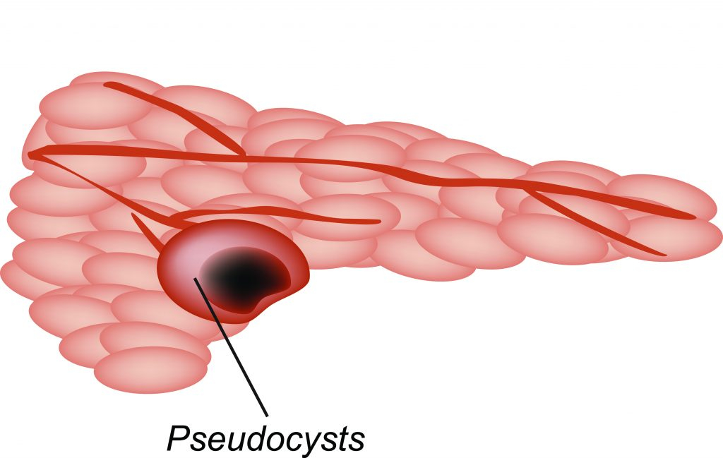Pancreatic-Pseudocyst